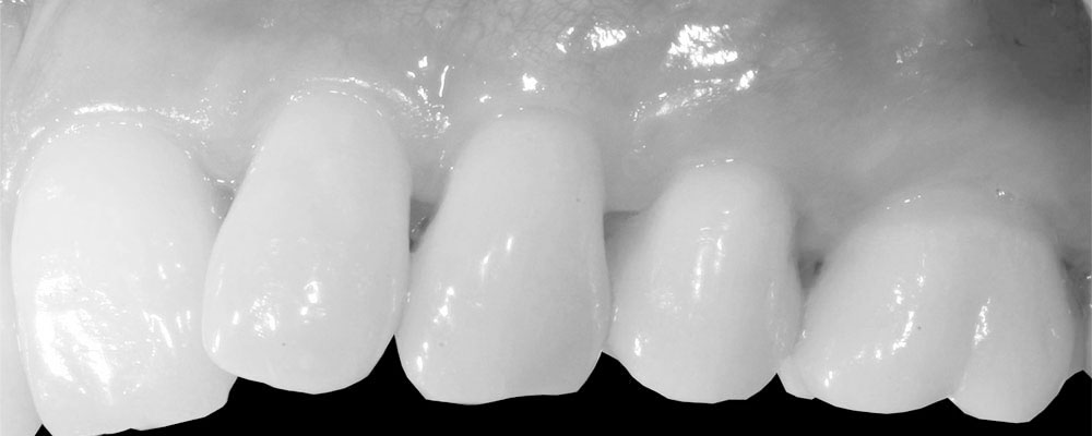 gingival graft by Sylvain Mouraret, Periodontist at Nice