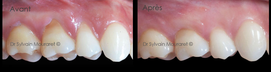 Gingival graft by Sylvain Mouraret, periodontist at Nice