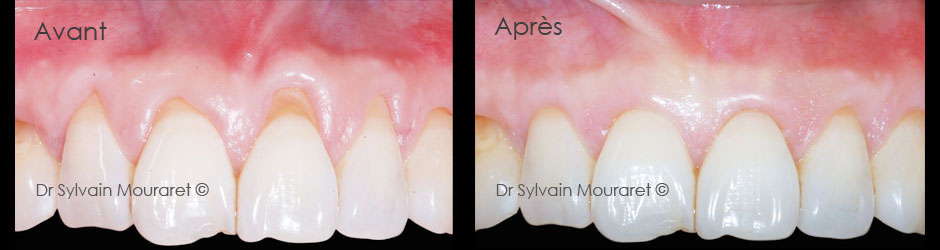 Gingival graft by Sylvain Mouraret, periodontist at Nice