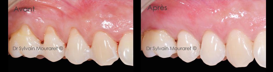 Gingival graft by Sylvain Mouraret, periodontist at Nice