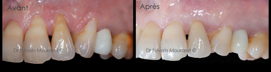 Gingival graft by Sylvain Mouraret, periodontist at Nice