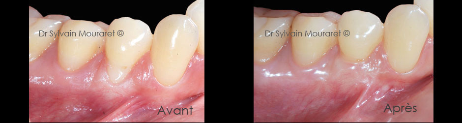 Gingival graft by Sylvain Mouraret, periodontist at Nice