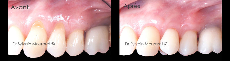 Gingival graft by Sylvain Mouraret, periodontist at Nice