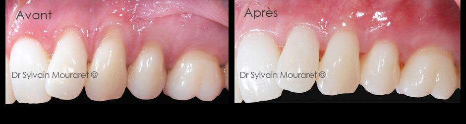 Gingival graft by Sylvain Mouraret, periodontist at Nice