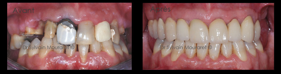 Dental Reconstruction by Sylvain Mouraret, periodontist at Nice 