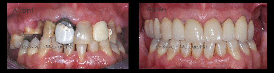 Reconstruction globale par Sylvain Mouraret, parodontiste à Nice