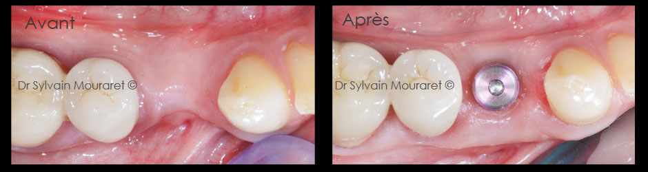 Alveolar crest reconstruction by Sylvain Mouraret, periodontist at Nice 