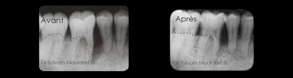 Tissue regenerqtion by Sylvain Mouraret, periodontist at Nice 
