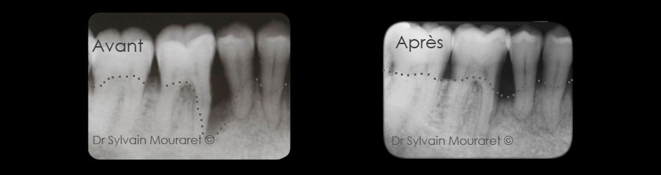 Régénération tissulaire par Sylvain Mouraret, parodontiste à Nice