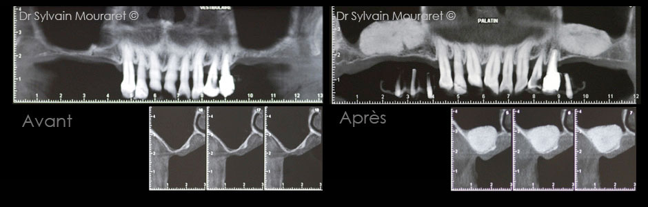 Greffe osseuse sous sinusienne par Sylvain Mouraret, parodontiste à Nice