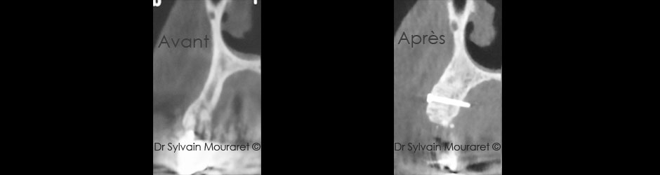 Bone graft by Sylvain Mouraret, periodontist at Nice 