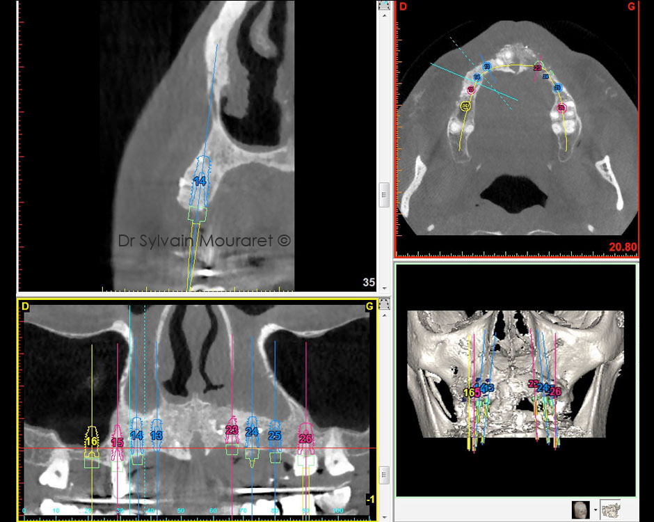 Computer assited surgery by Sylvain Mouraret, periodontist at Nice 